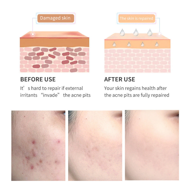 Acne Scar Removal Gel